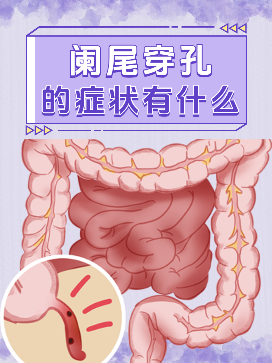 阑尾切口位置图图片