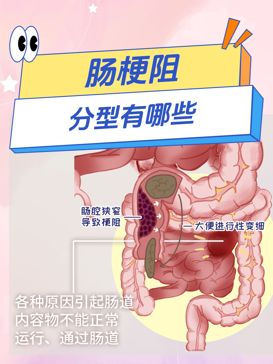 肠不完全梗阻最佳打通方法