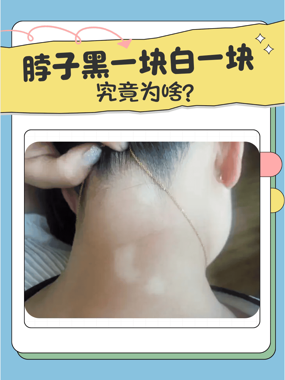 脖子黑一块白一块,究竟为啥?