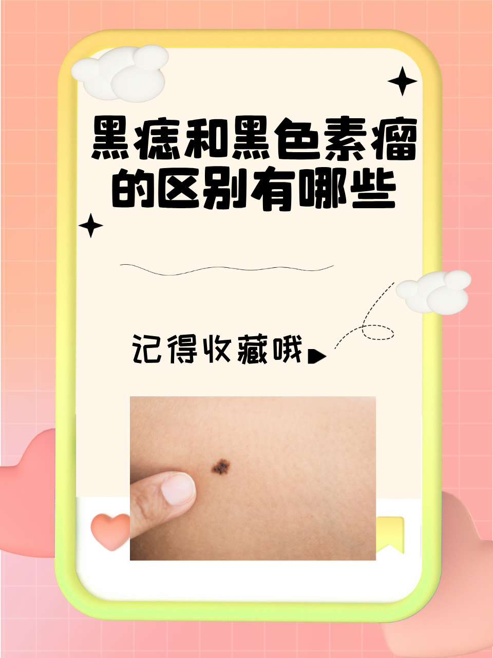 黑痣和黑色素瘤的区别有哪些  黑痣和黑色素瘤,一字之差,天壤之别!