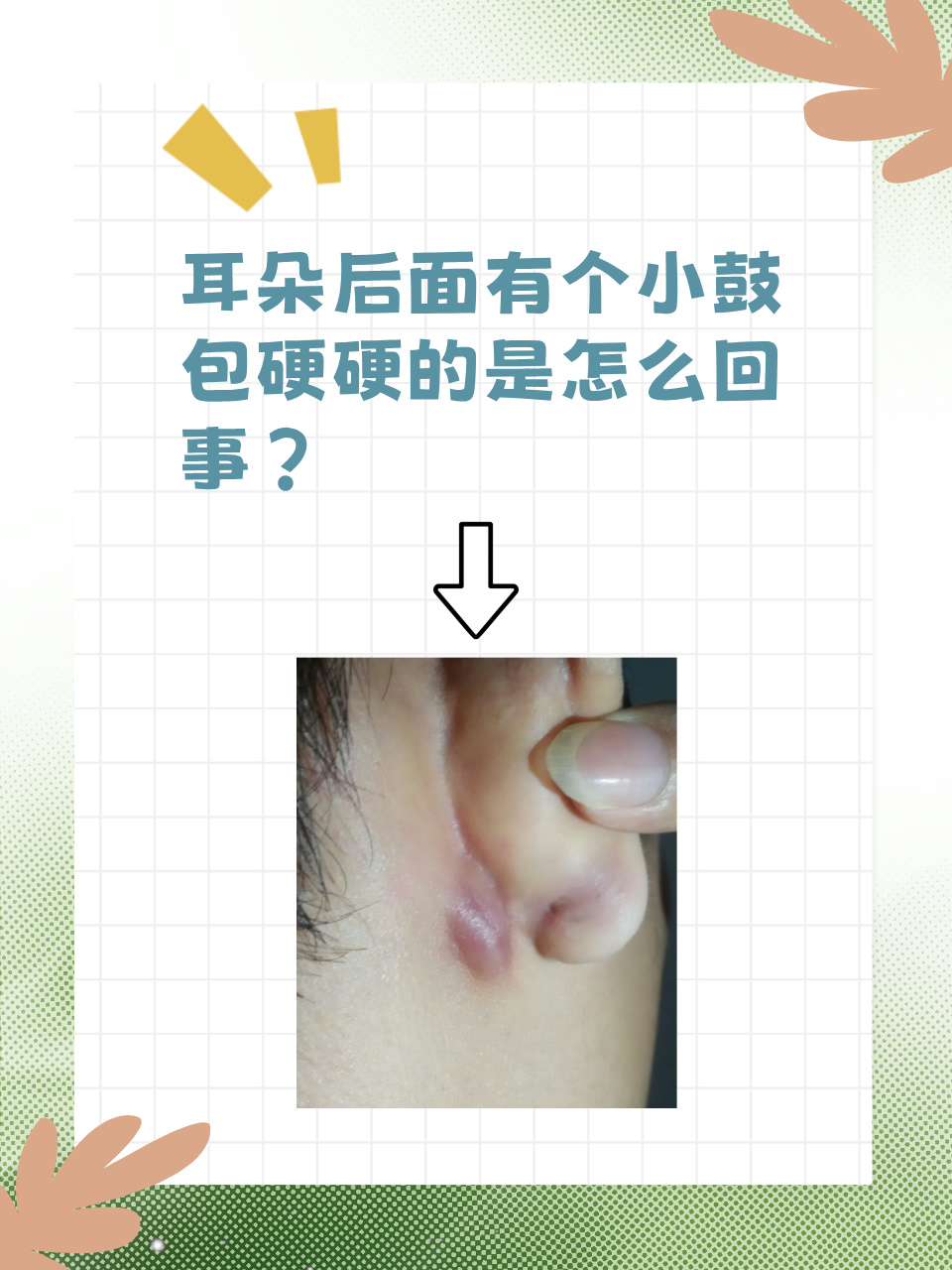 耳朵后面有个小鼓包硬硬的是怎么回事?
