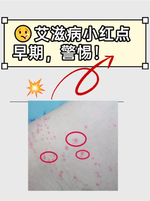 不过,红点不是艾滋病特有的症状,其他一些情况也可能导致腿上有红点