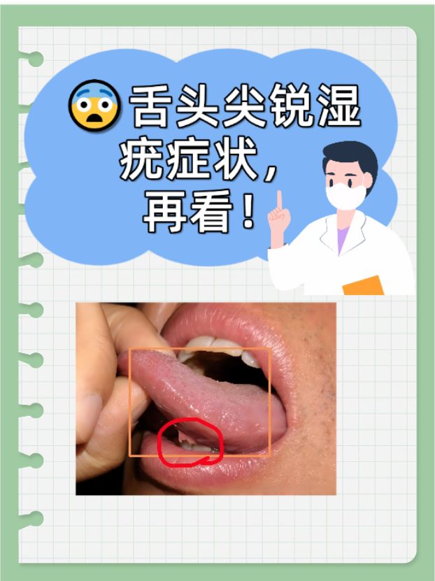 症状表现通常为舌头上出现的小丘疹,菜花状或乳头状的赘生物