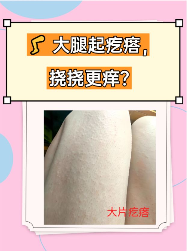 大腿起一片一片疙瘩且挠后更痒的常见原因: 皮肤过敏:接触过敏原,如