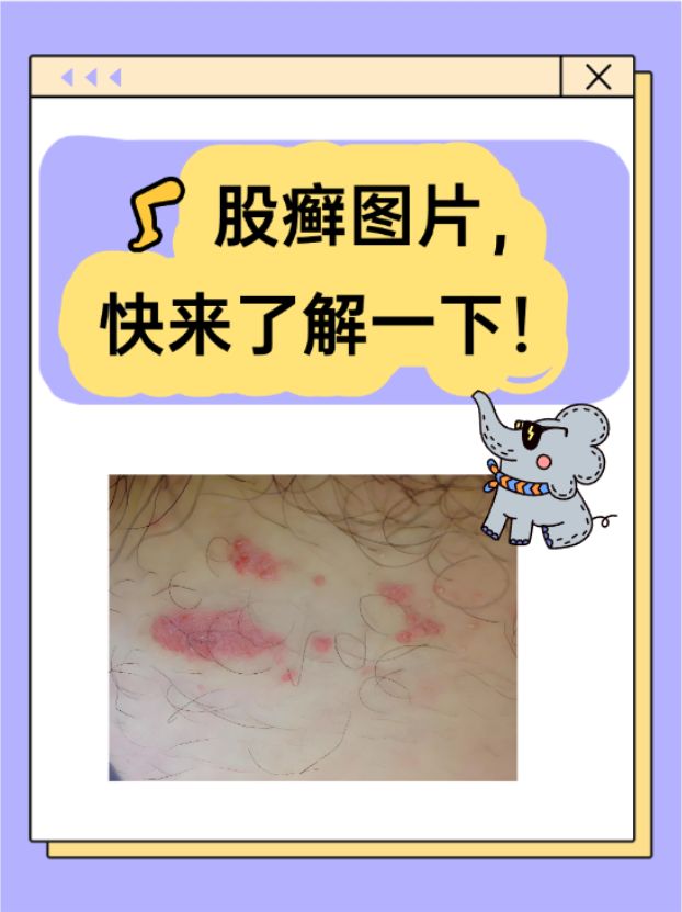 首先,股癣是由真菌感染引起的皮肤疾病,常见于腹股沟,会阴部和肛值热