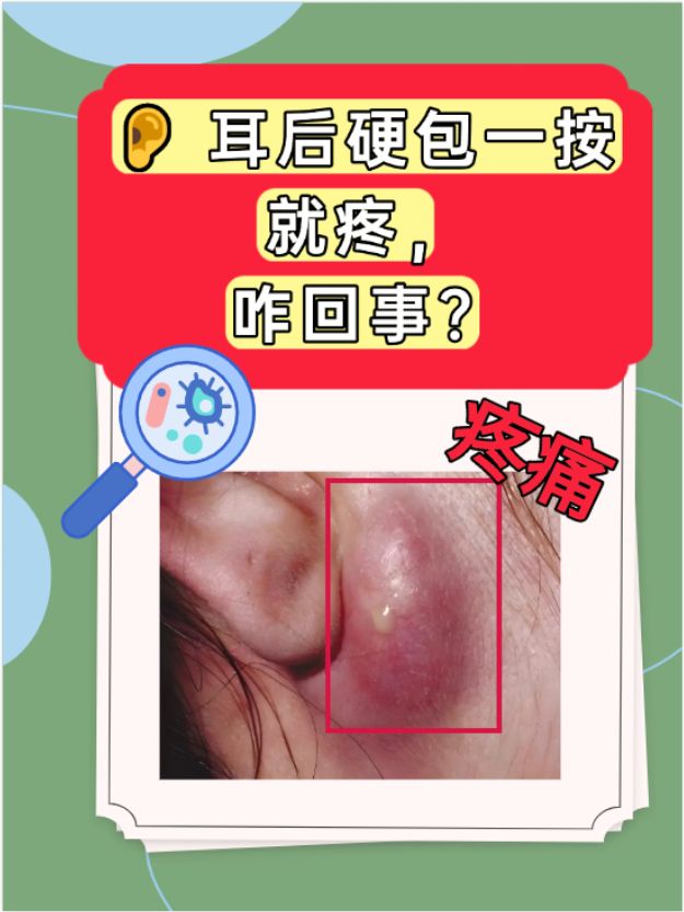 比如淋巴结肿大,皮脂腺囊肿感染,毛囊炎等,这些情况会导致耳后局部