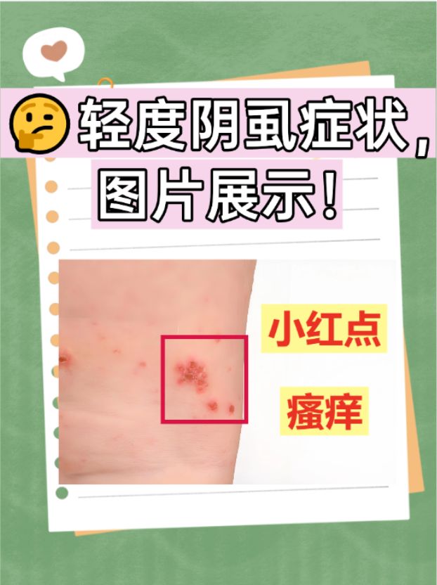 首先,我们要明确,阴虱是一种常见的性传播疾病,主要通过亲密接触传播