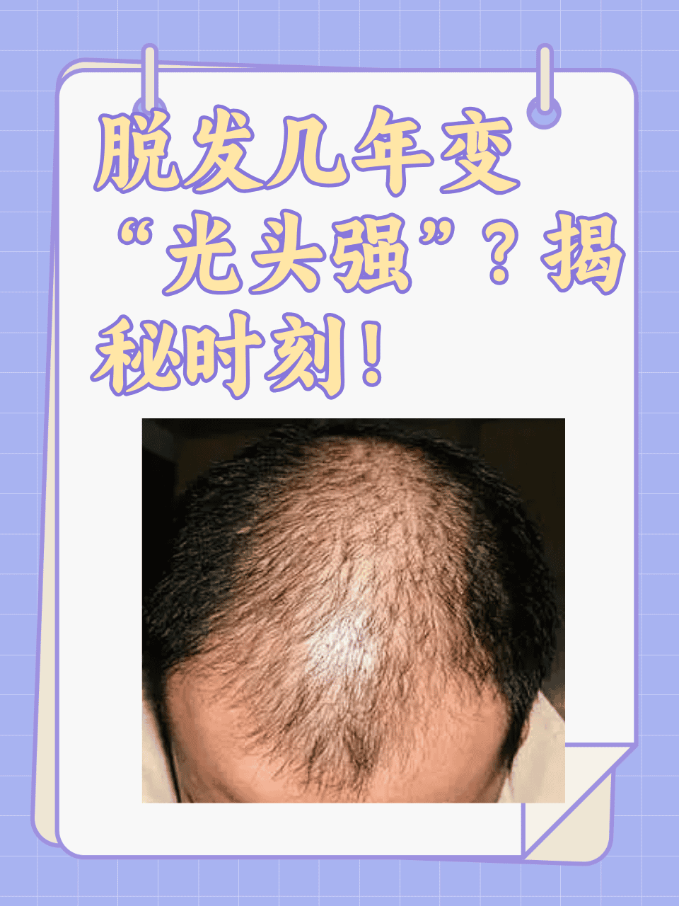 为什么老是掉头发男生为什么在线