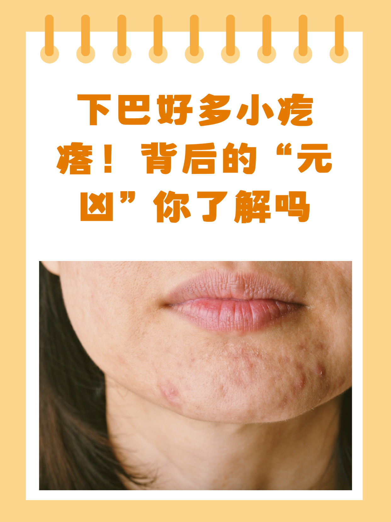 为什么下巴老是长痘痘又疼又硬为什么在线 为什么下巴老是长痘痘又疼又硬为什么在线