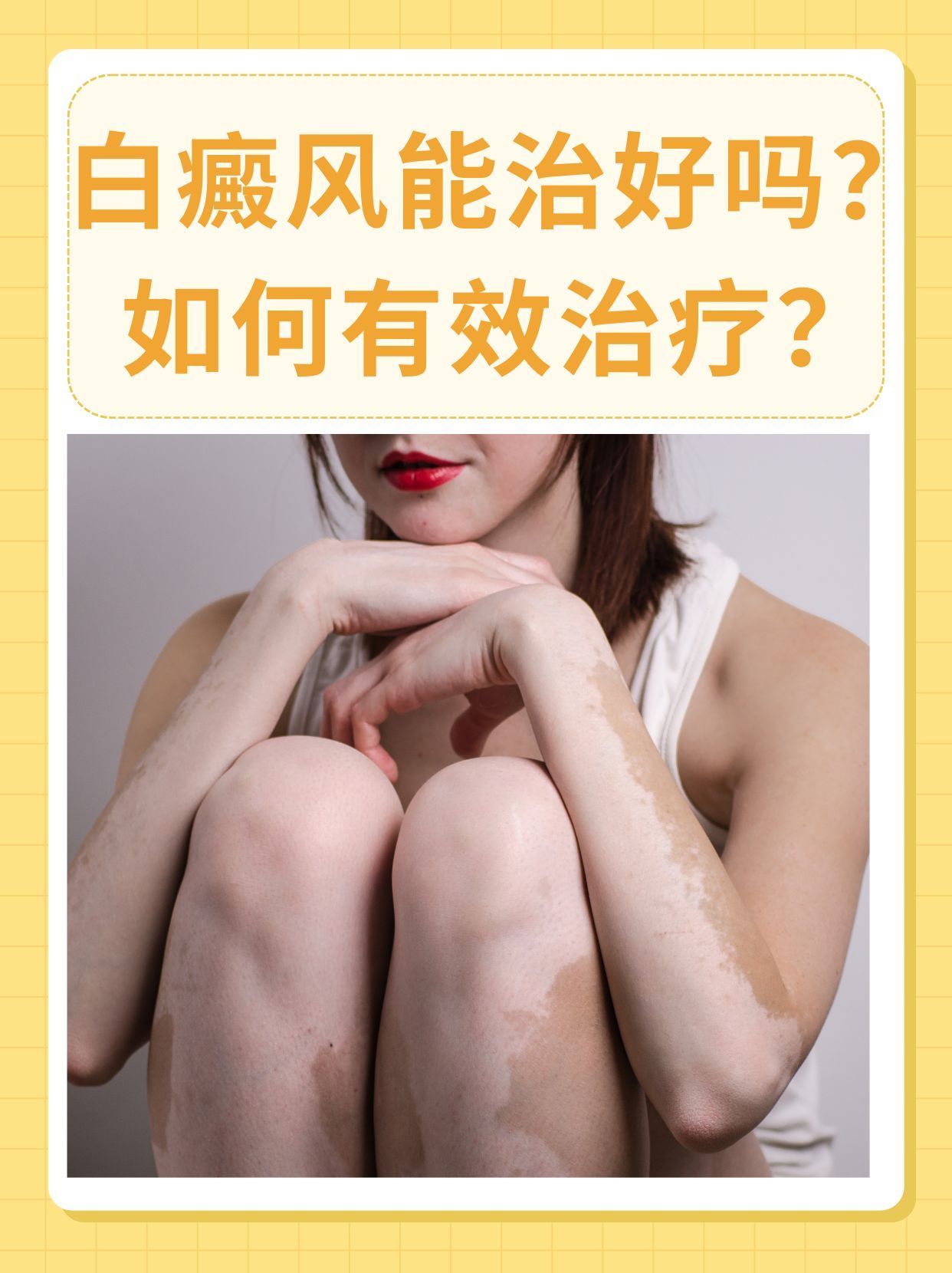 白癜风治疗