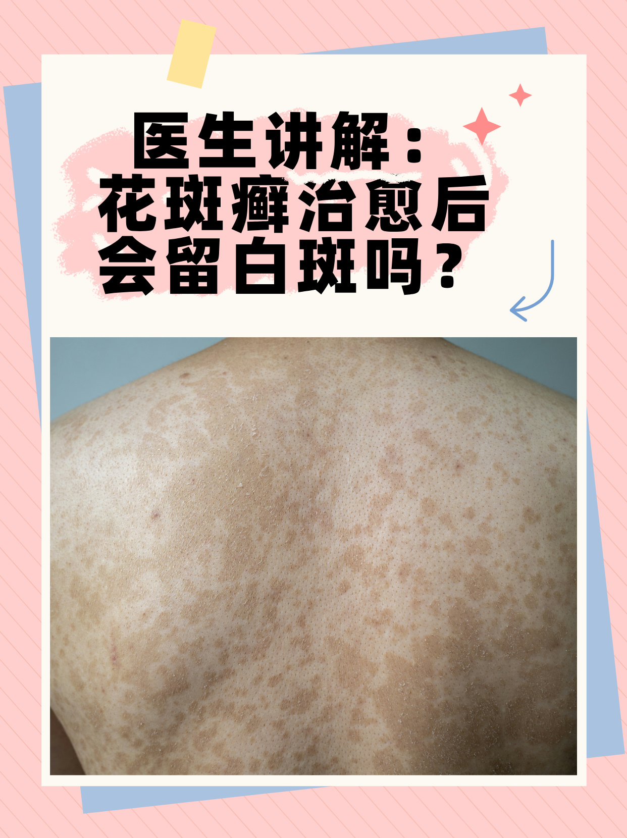 医生讲解:花斑癣治愈后会留白斑吗?
