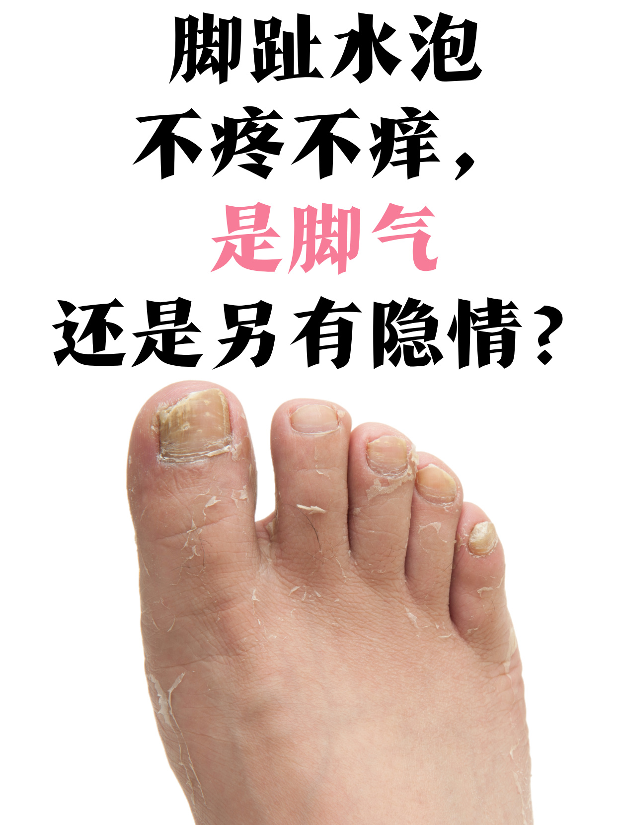 为什么脚会长水泡百科在线 为什么脚会长水泡百科在线