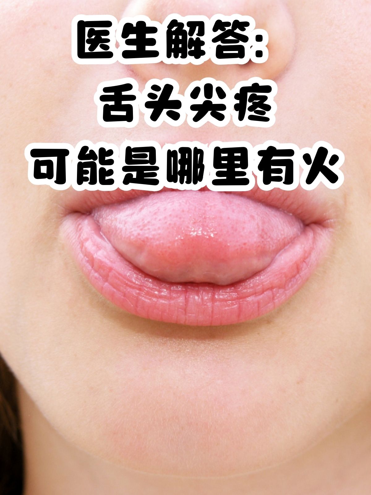 医生解答:舌头尖疼可能是哪里有火 在日常生活中,舌头尖疼是一种常见