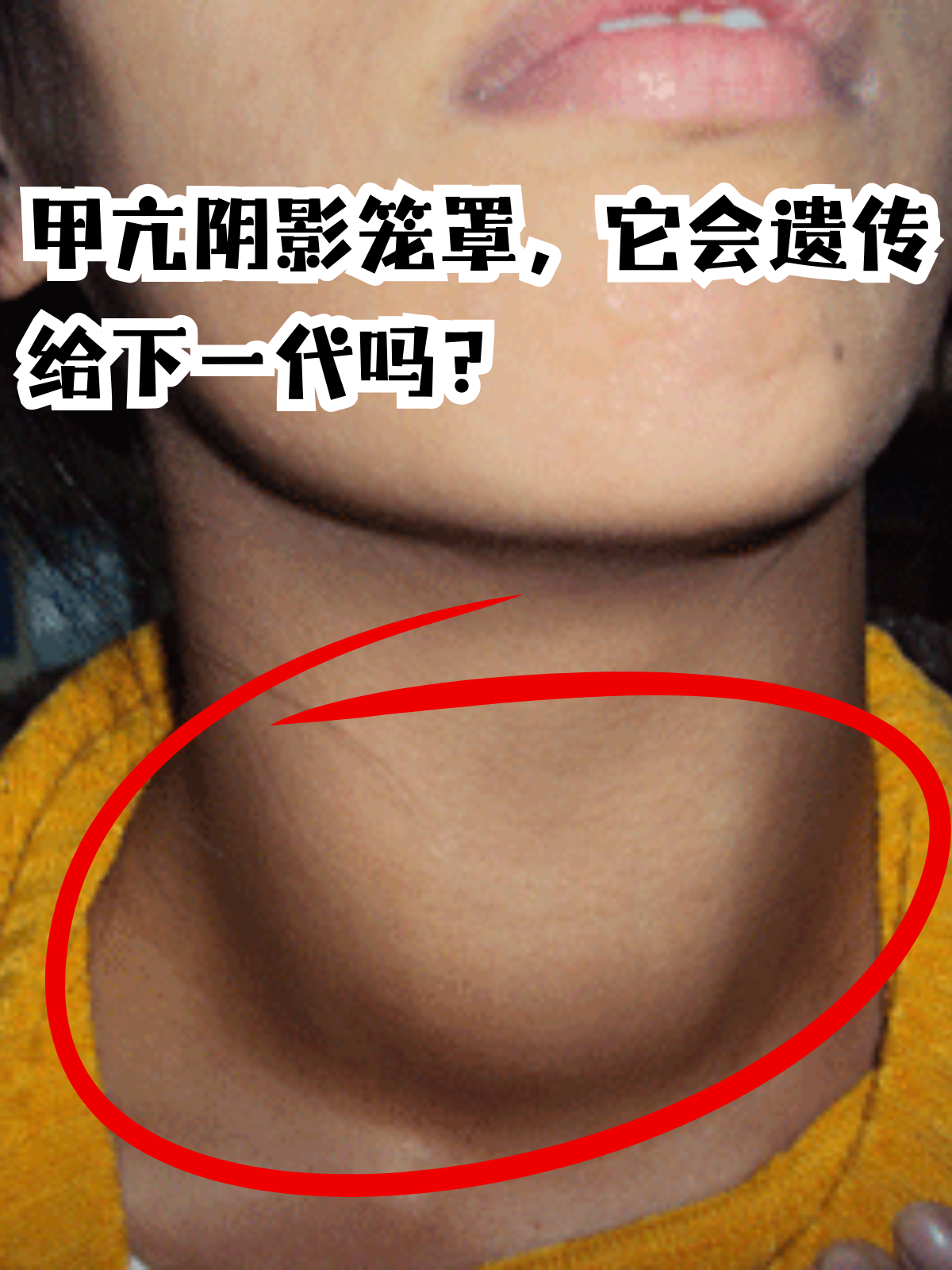 甲亢阴影笼罩,它会遗传给下一代吗.@琳狐乖a的动态