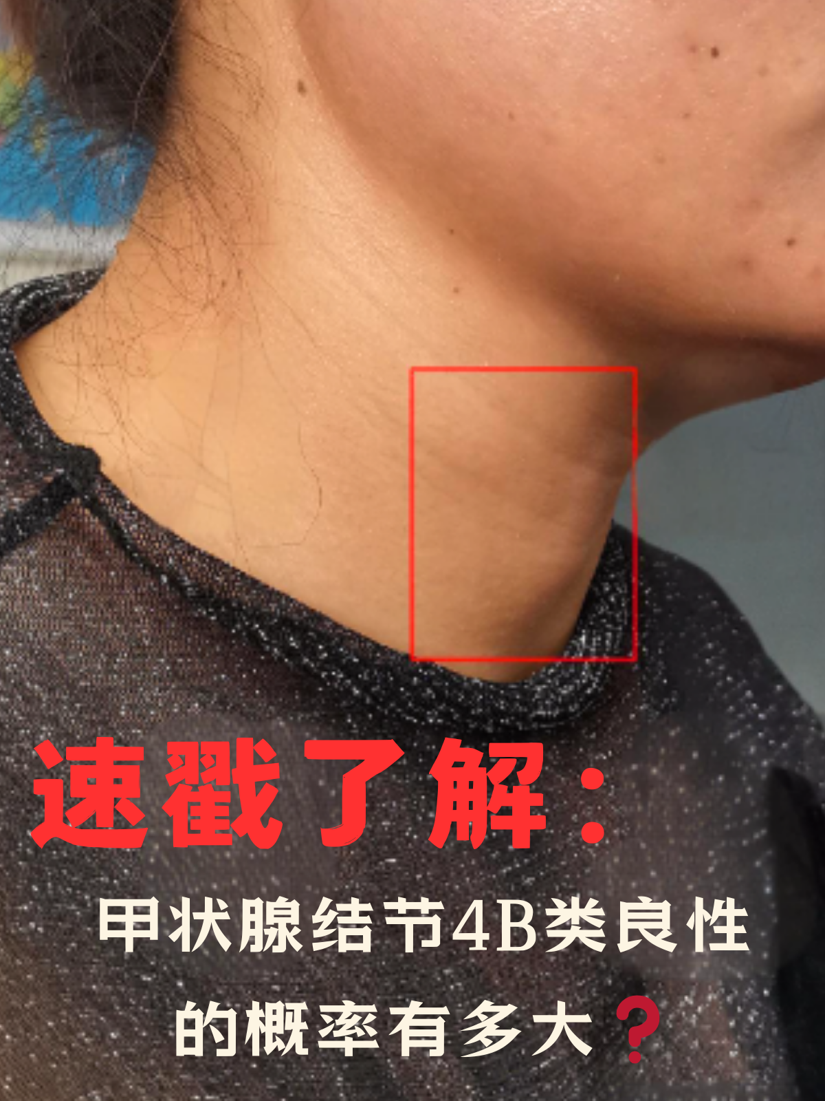 速戳了解甲状腺结节4b类良性的概率有多大❓