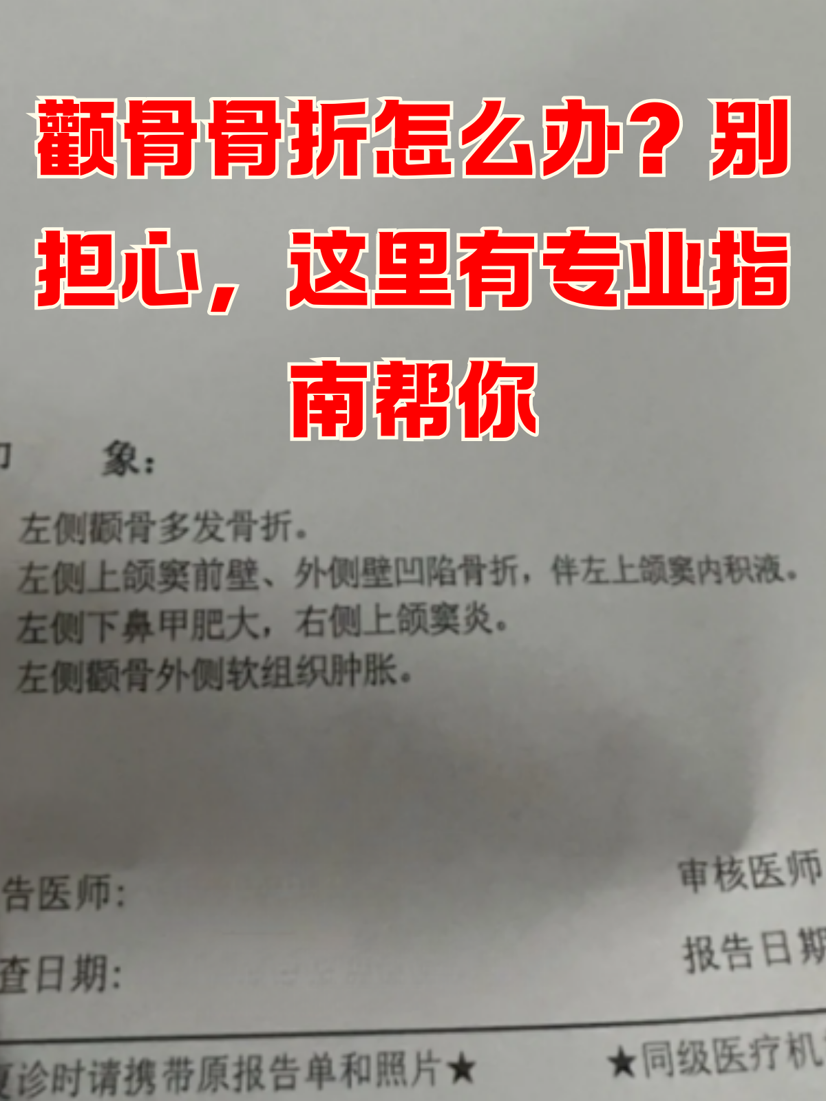 颧骨骨折怎么办?
