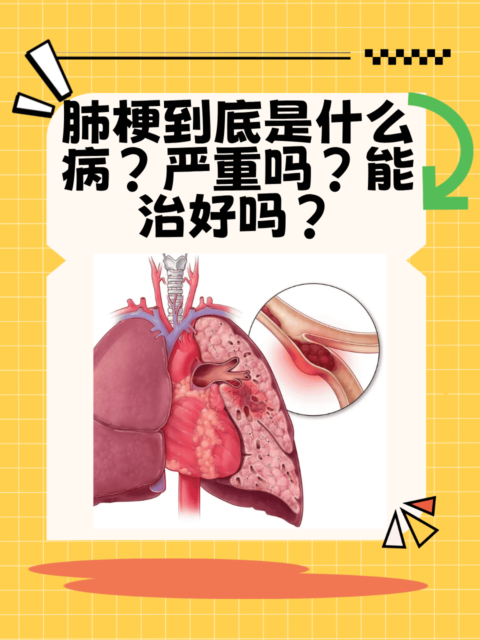 肺梗这个病名相信很多人都有些陌生,这到底是一种什么样的病呢?