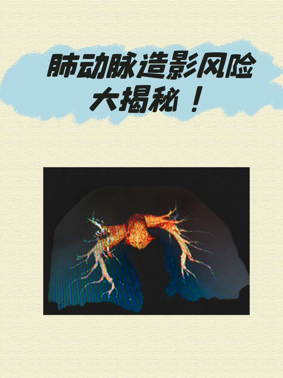 肺动脉造影这个检查听起来就很复杂呢