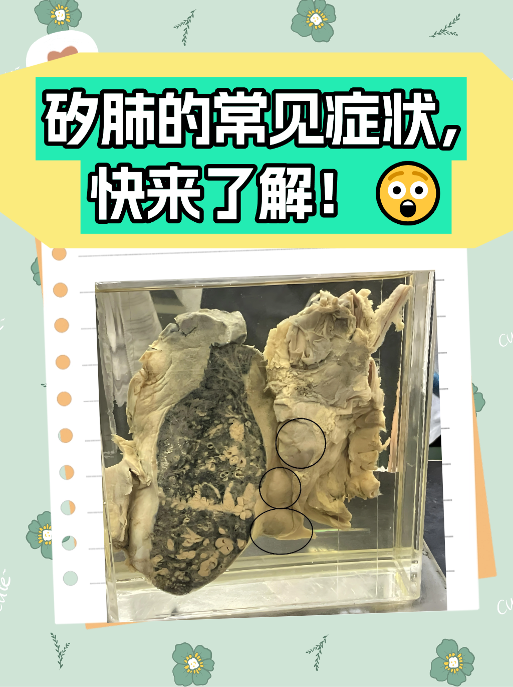 矽肺是由于长期吸入大量含有游离二氧化硅的粉尘所引起的肺部疾病,其