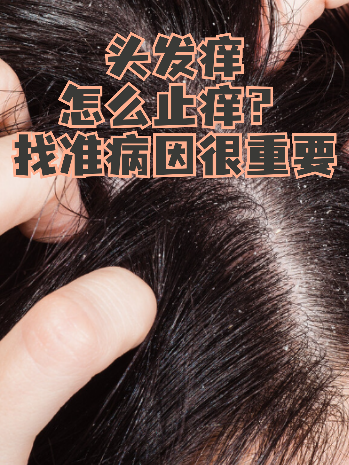 为什么头皮一直很痒