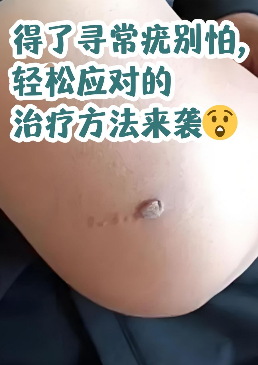 大腿根部的寻常疣照片图片