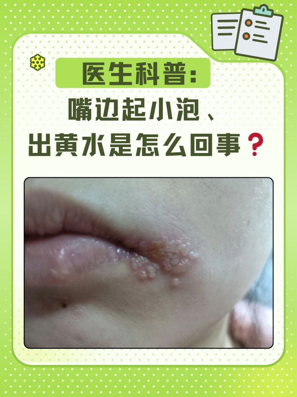 医生科普:嘴边起小泡,出黄水是怎么回事71 你有没有这样的经历,早上