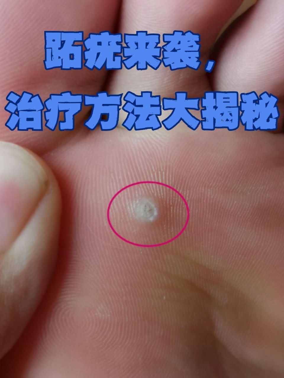 跖疣来袭,治疗方法大揭秘 跖疣是我们生活中常见的一种皮肤病,它是由