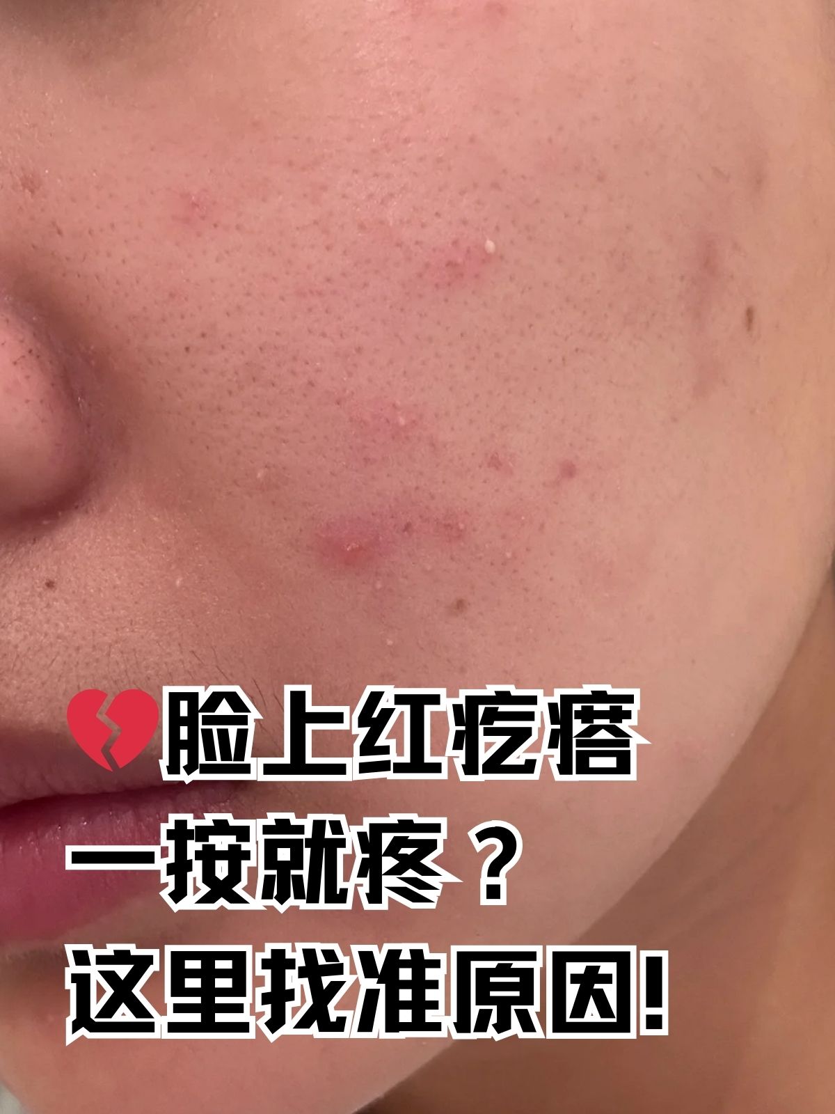 脸上长很多小粉刺是为什么