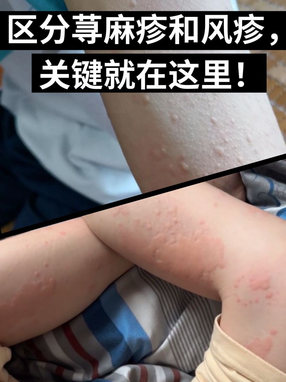 区分荨麻疹和风疹,关键就在这里!