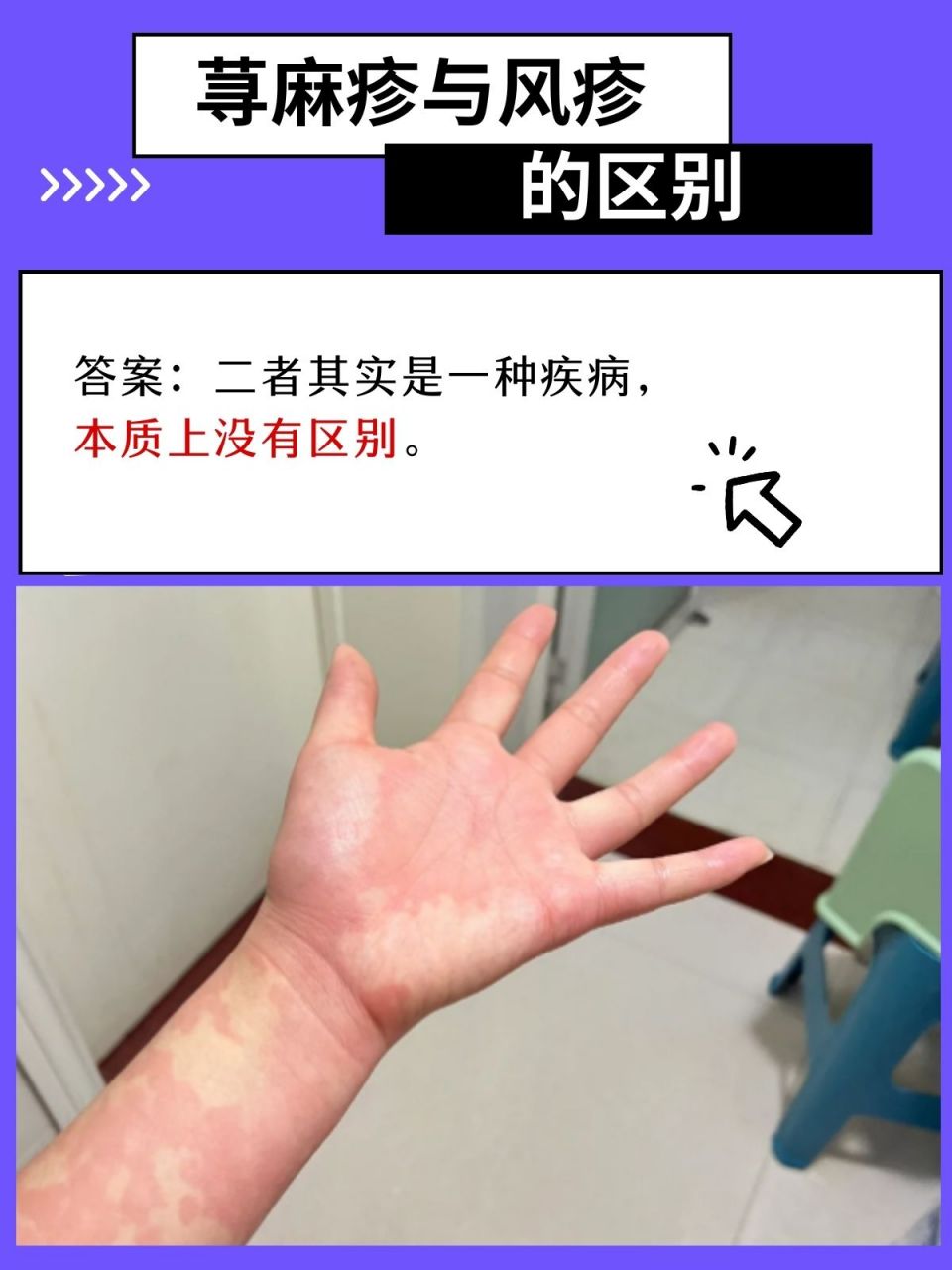 区分荨麻疹和风疹,关键就在这里!