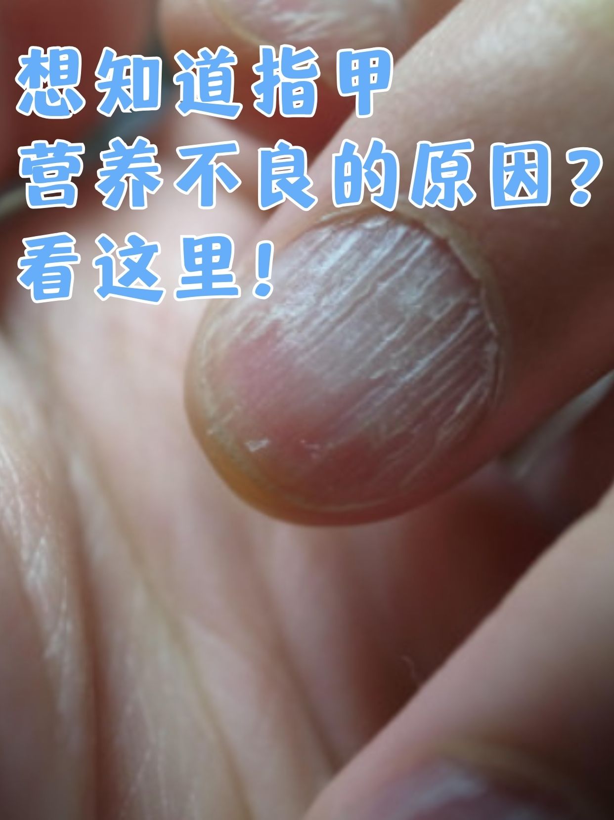 想知道指甲营养不良的原因?看这里!