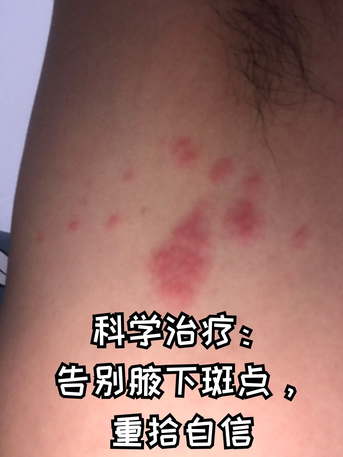 科学治疗:告别腋下斑点,重拾自信 花斑糠疹,是一种由马拉色菌(一种