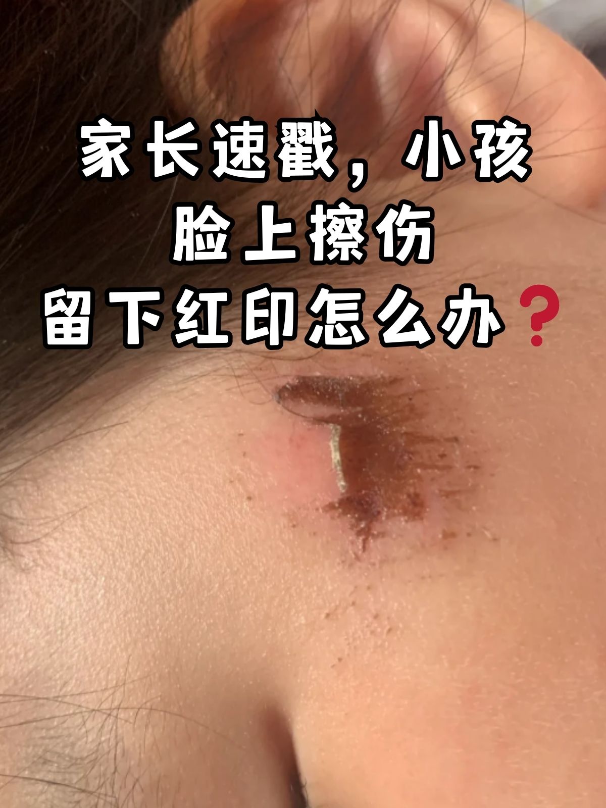 擦伤后皮肤留下黑印怎么样才能消除脸上摔伤后留下的黑印怎么去除脸