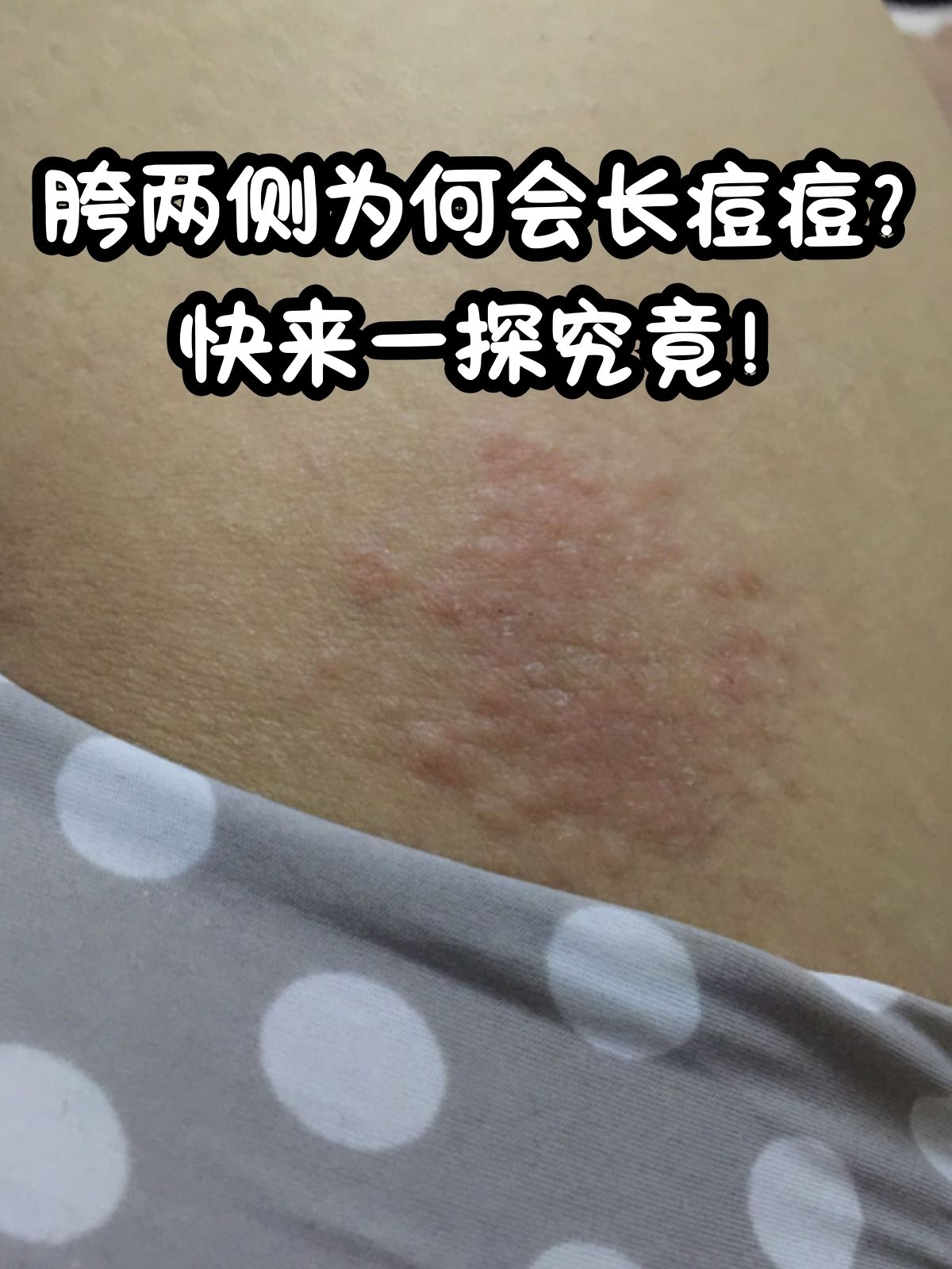 背后为什么会长痘为什么在线