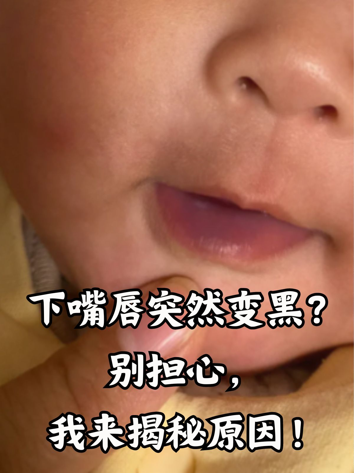 别担心,我来揭秘原因! 下嘴唇变黑,可能是由于多种原因导致的