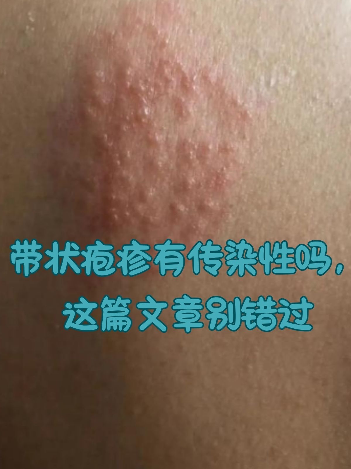 带状疱疹有传染性吗,这篇文章别错过 带状疱疹,这个常常让人闻之色变
