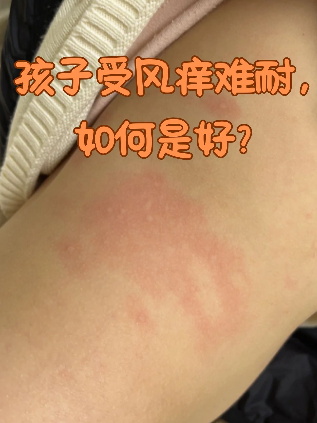 孩子的皮肤娇嫩敏感,一旦受风后瘙痒难耐,这可让家长们心疼又着急