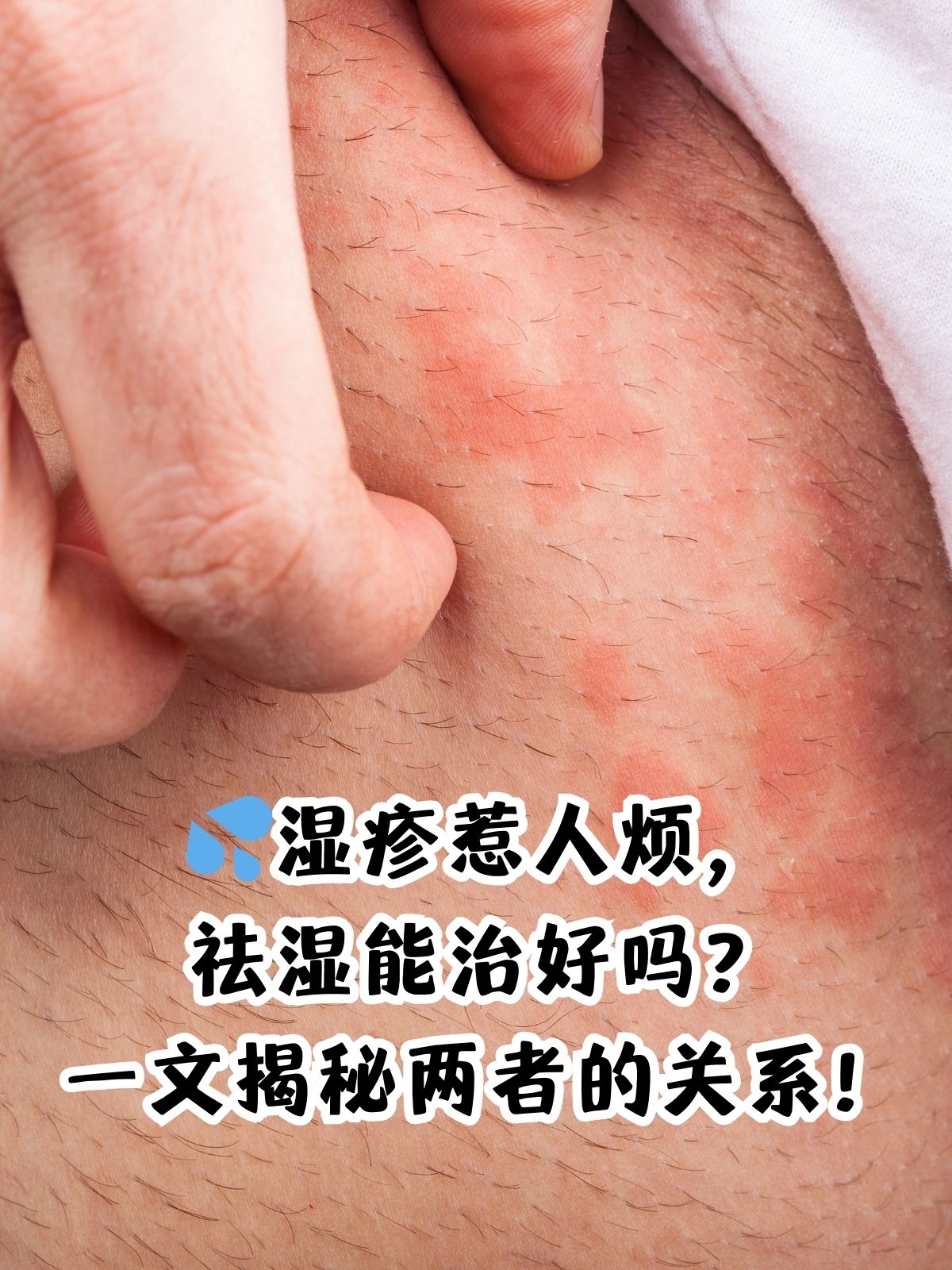 为什么会长湿疹