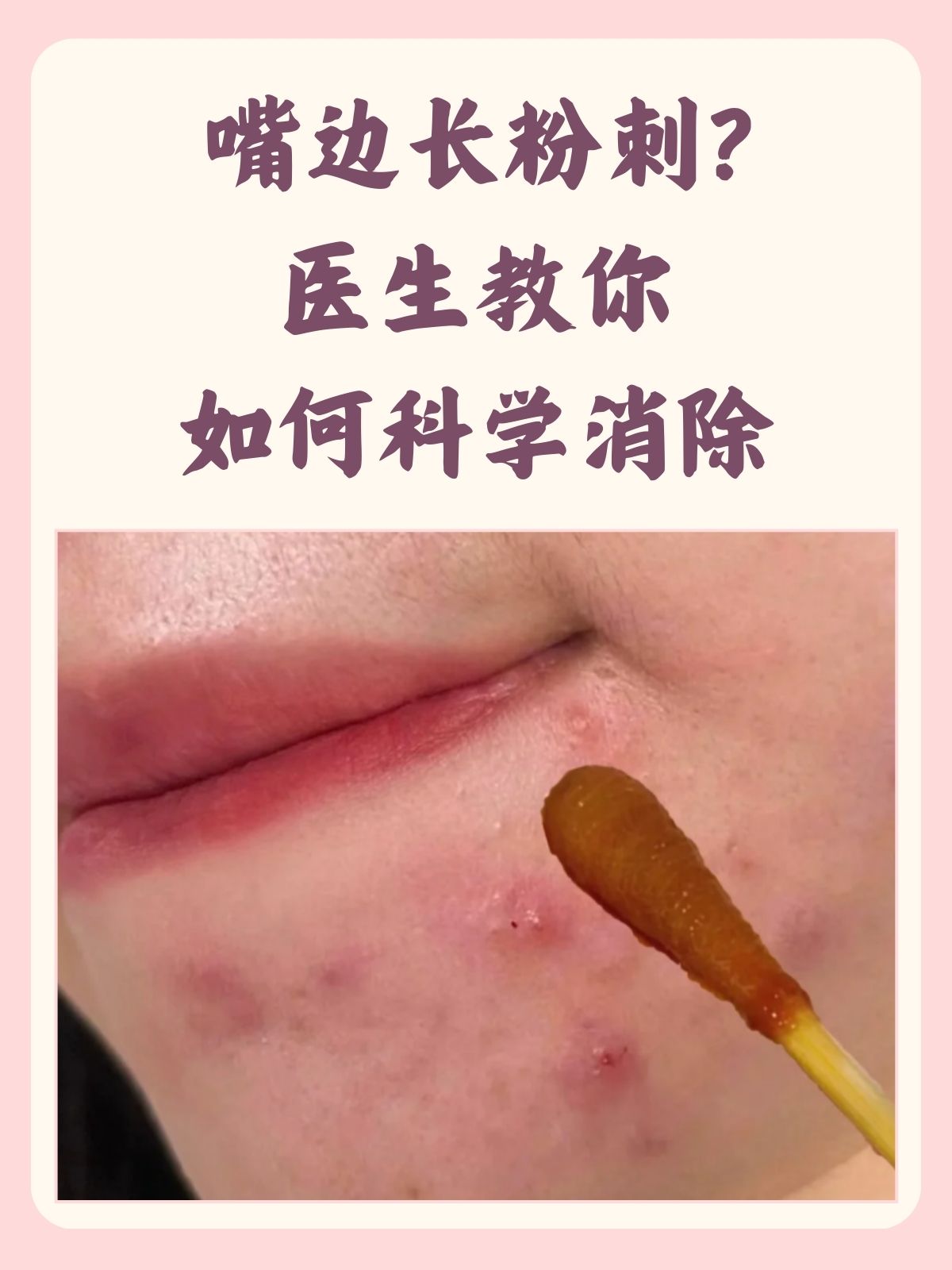 正常毛囊皮脂腺图片