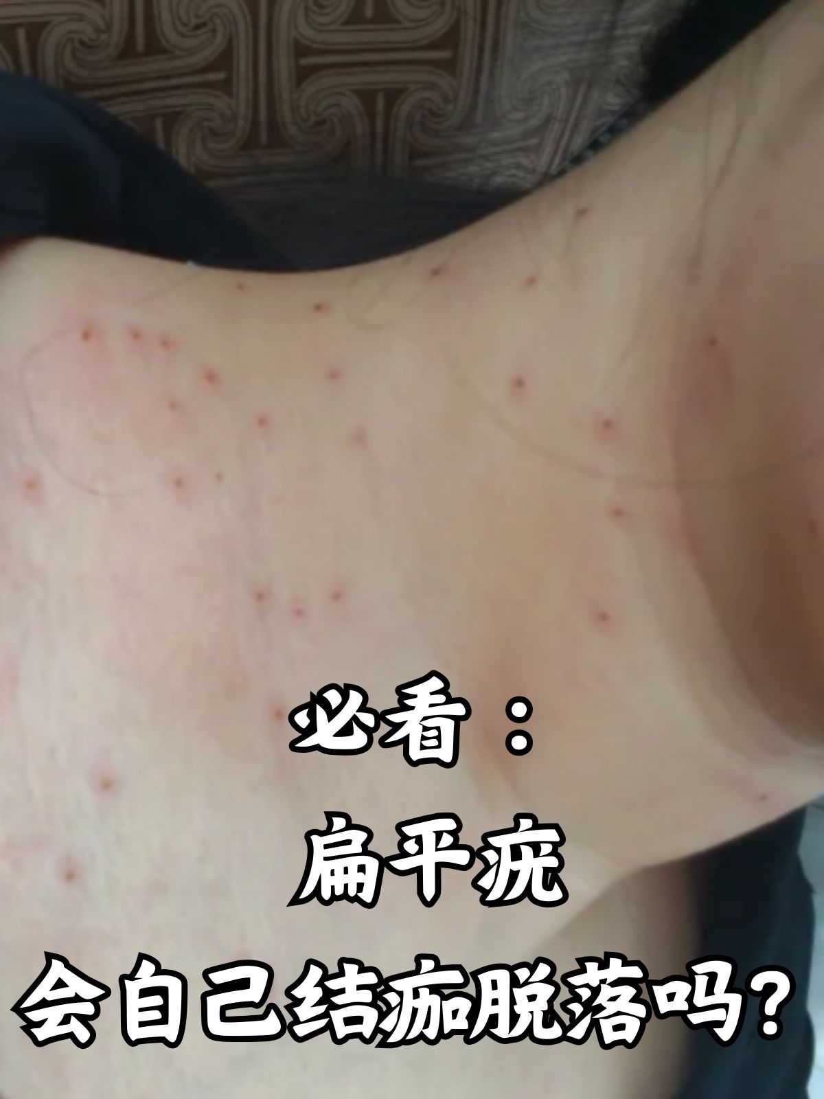 必看:扁平疣会自己结痂脱落吗?