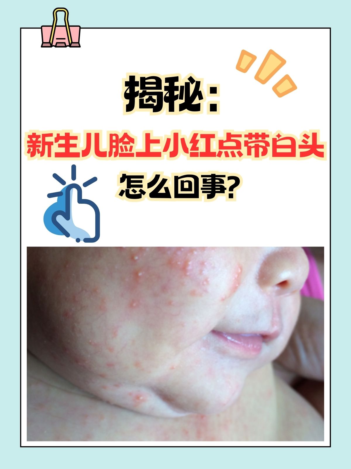 新手爸妈们,是不是有时候看着新生儿脸上突然出现的小红点带白头