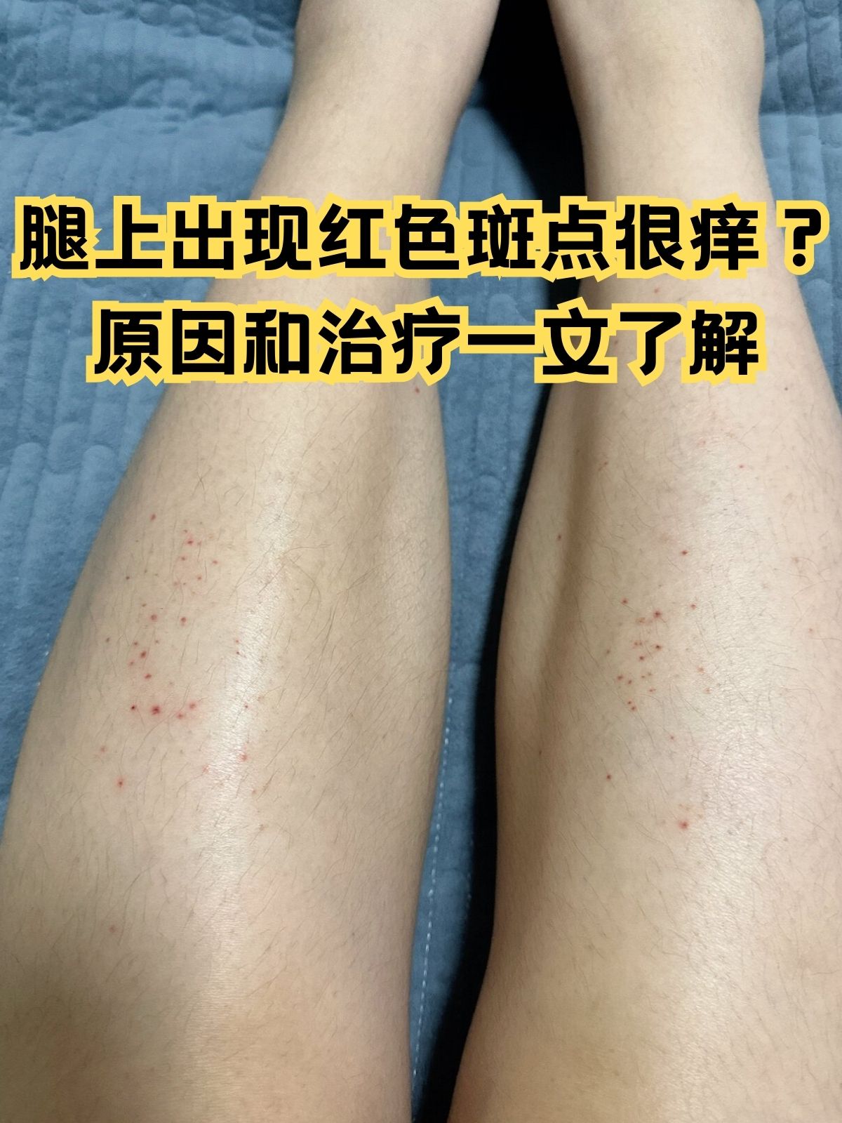 原因和治疗一文了解 腿上突然出现了一些红色的斑点,并且非常痒