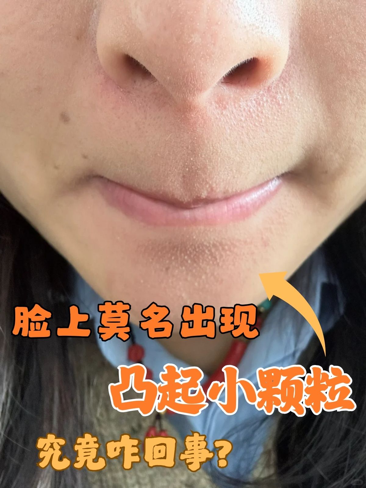 脸上凸起的小颗粒,是许多人在日常生活中可能遇到的一种皮肤问题