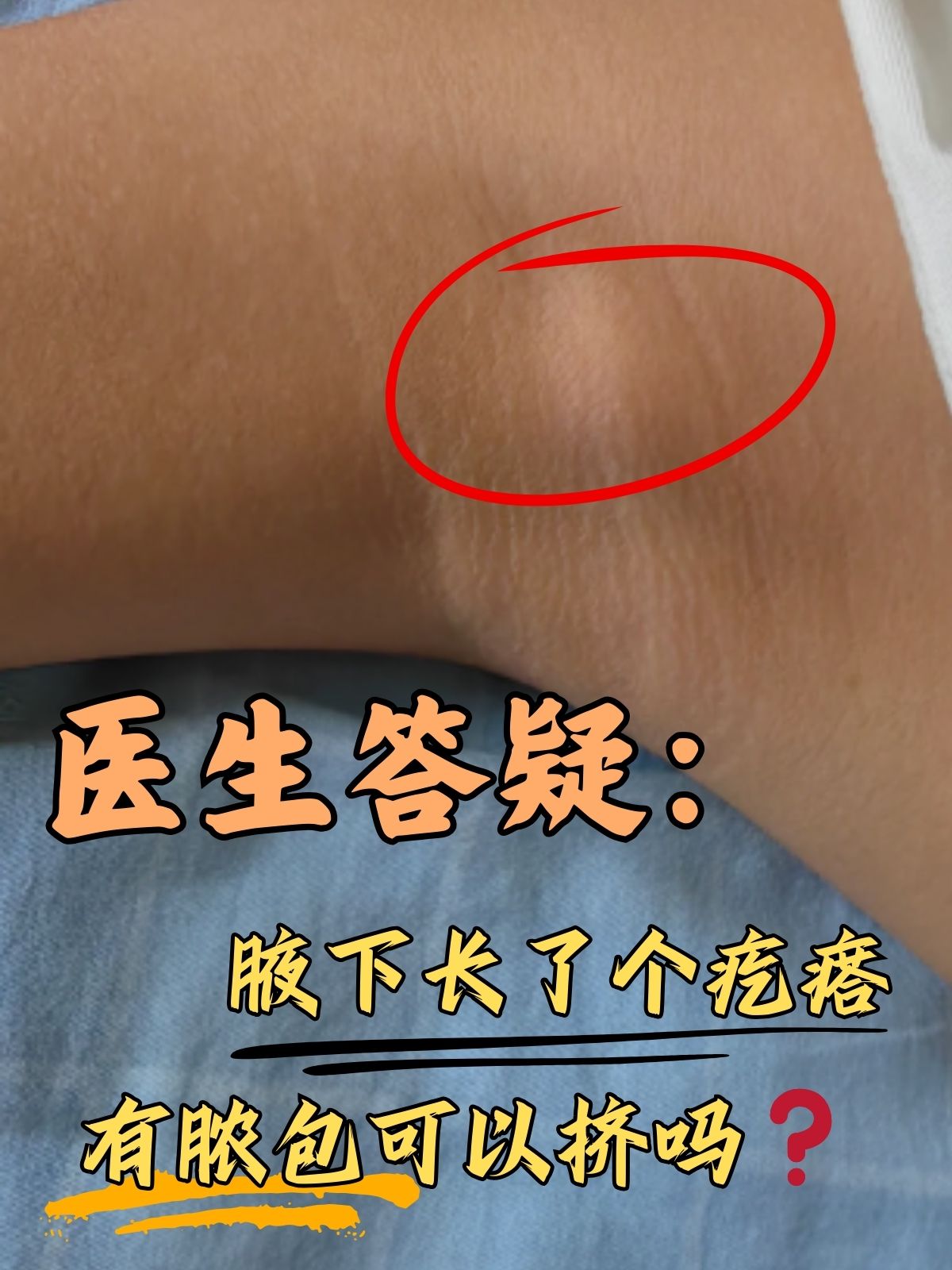 医生答疑:腋下长了个疙瘩有脓包可以挤吗 腋下长了
