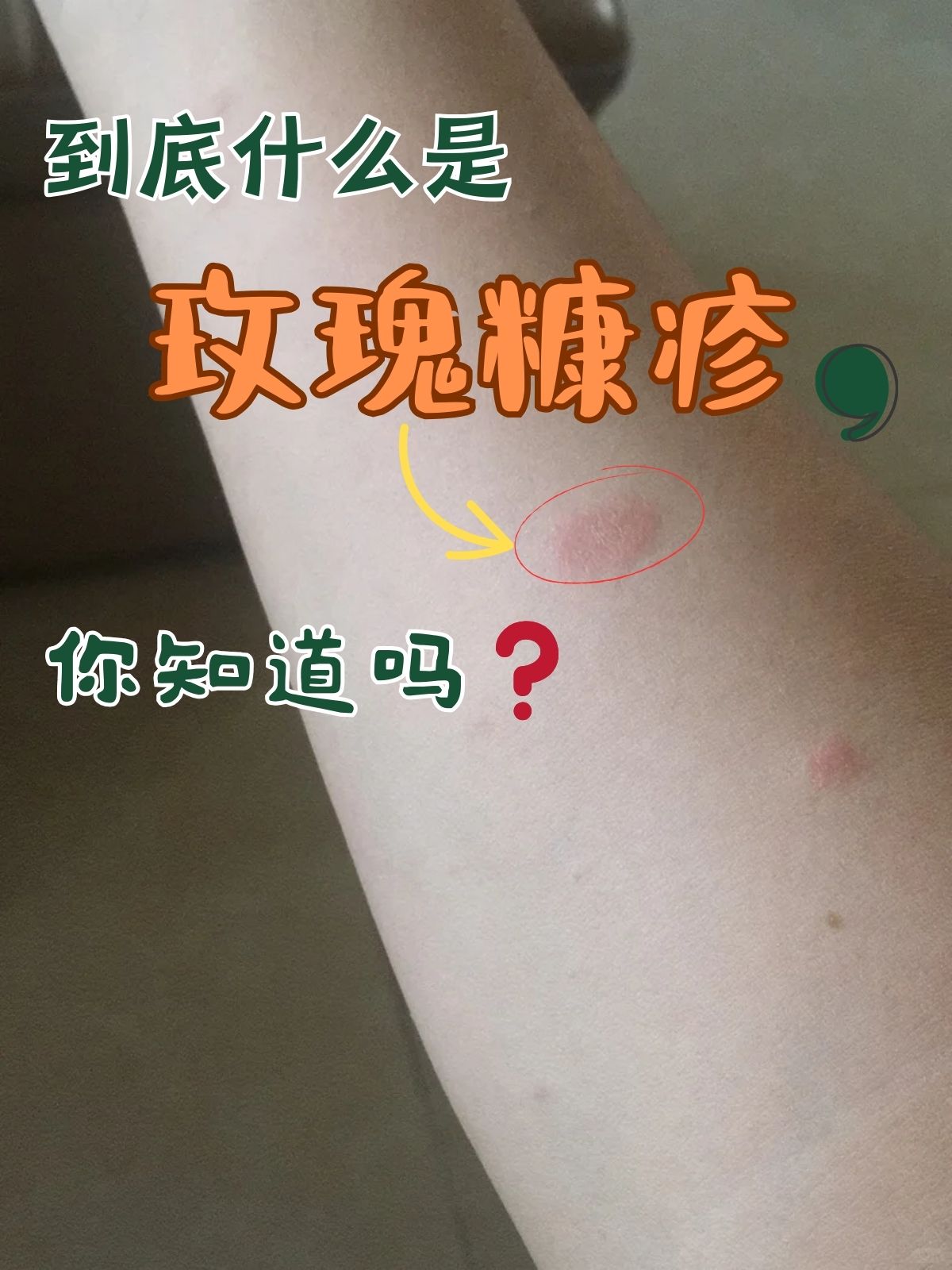 玫瑰糠疹是一种表现为玫瑰色斑疹,斑