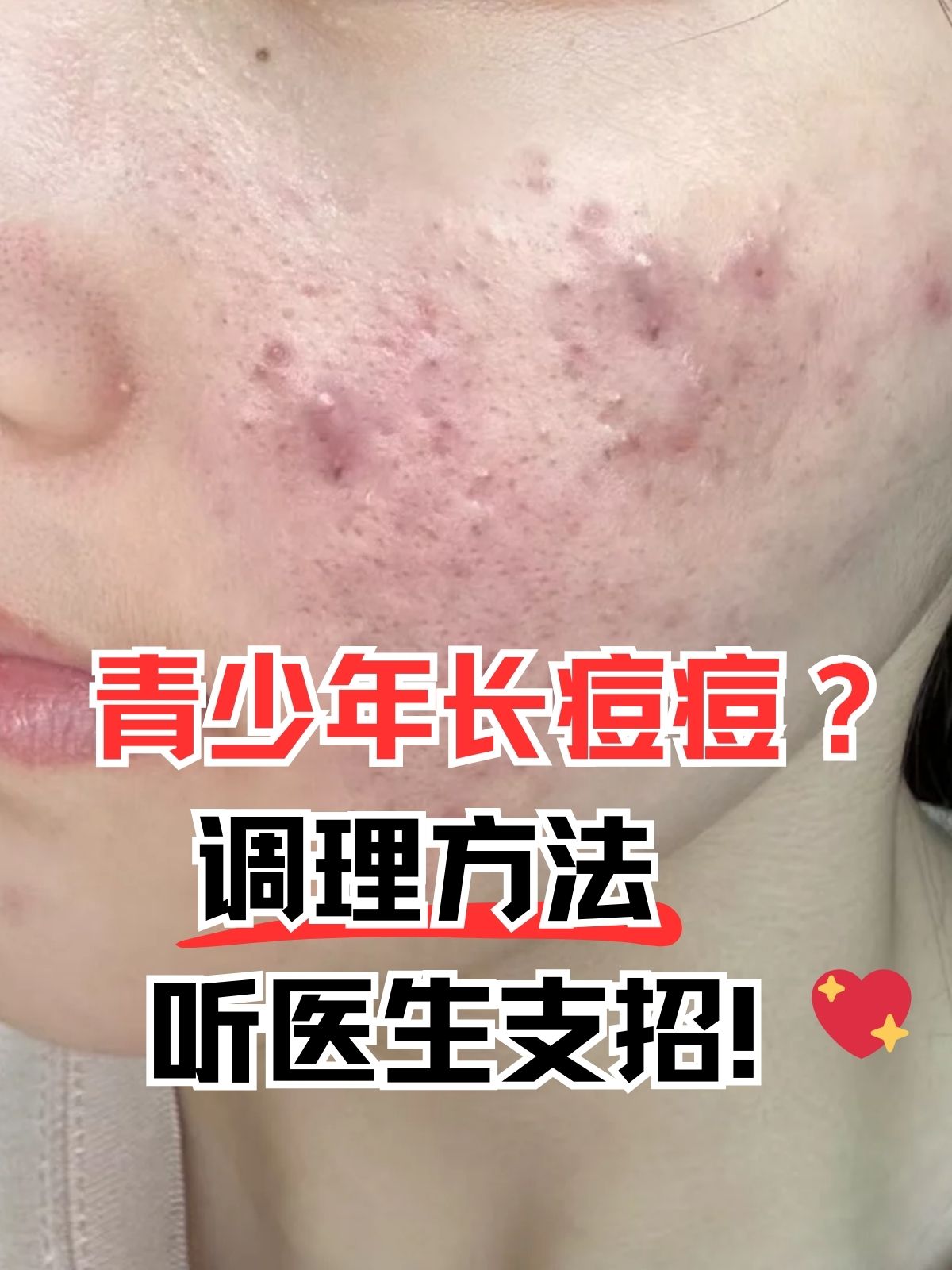 为什么要长痘痘脸上青春期百科在线