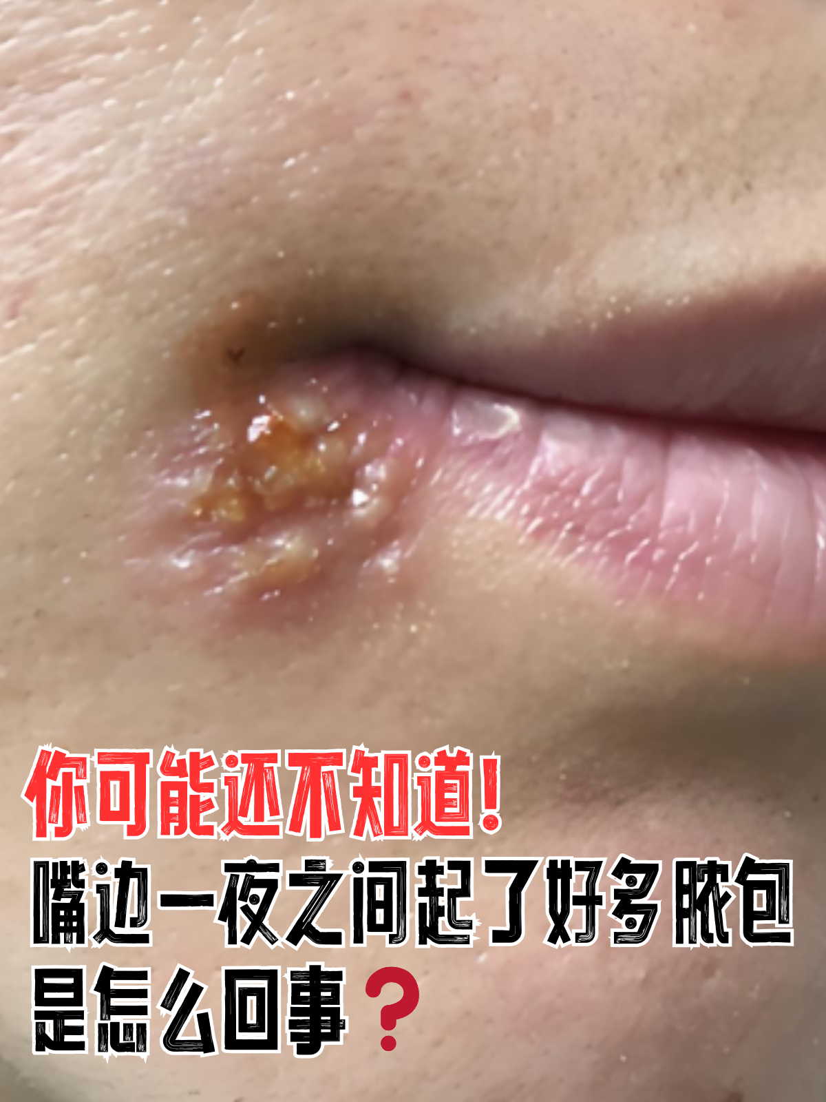 偶尔会遇到一些突发的皮肤问题,比如一夜之间嘴边突然冒出许多脓包