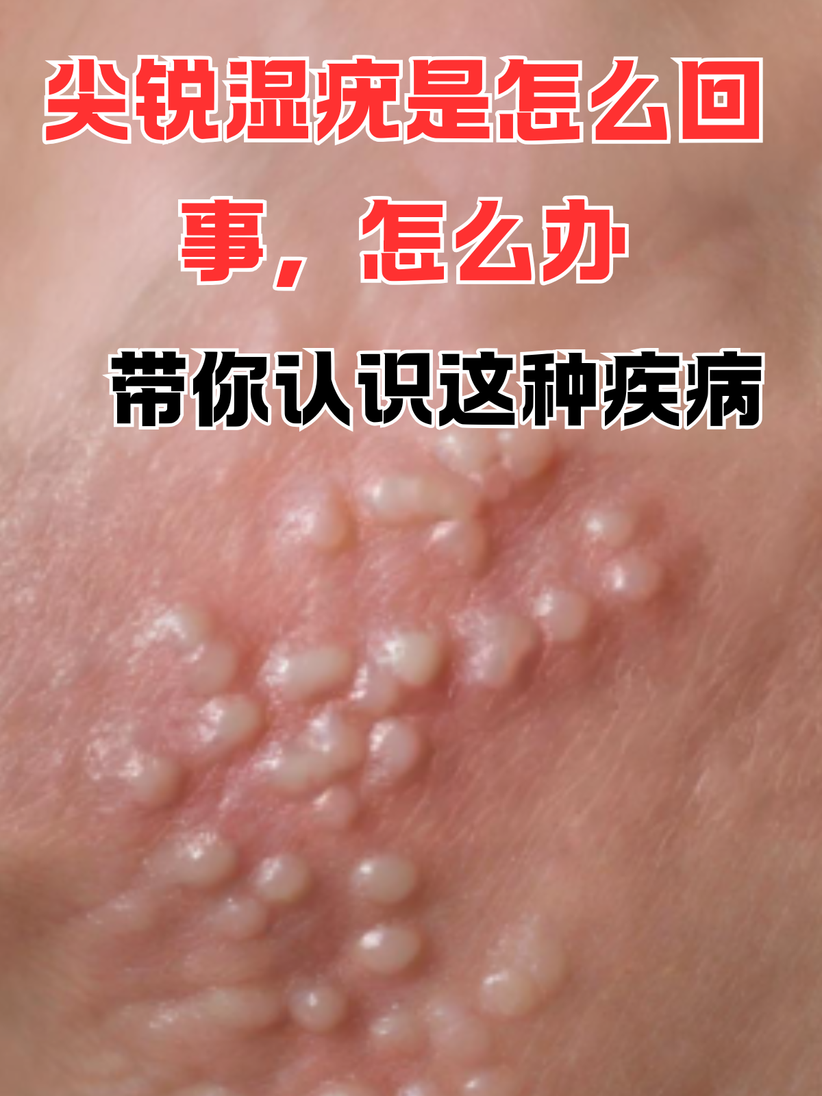 尖锐湿疣是怎么回事,怎么办,带你认识这种疾病 随着现代社会性观念的