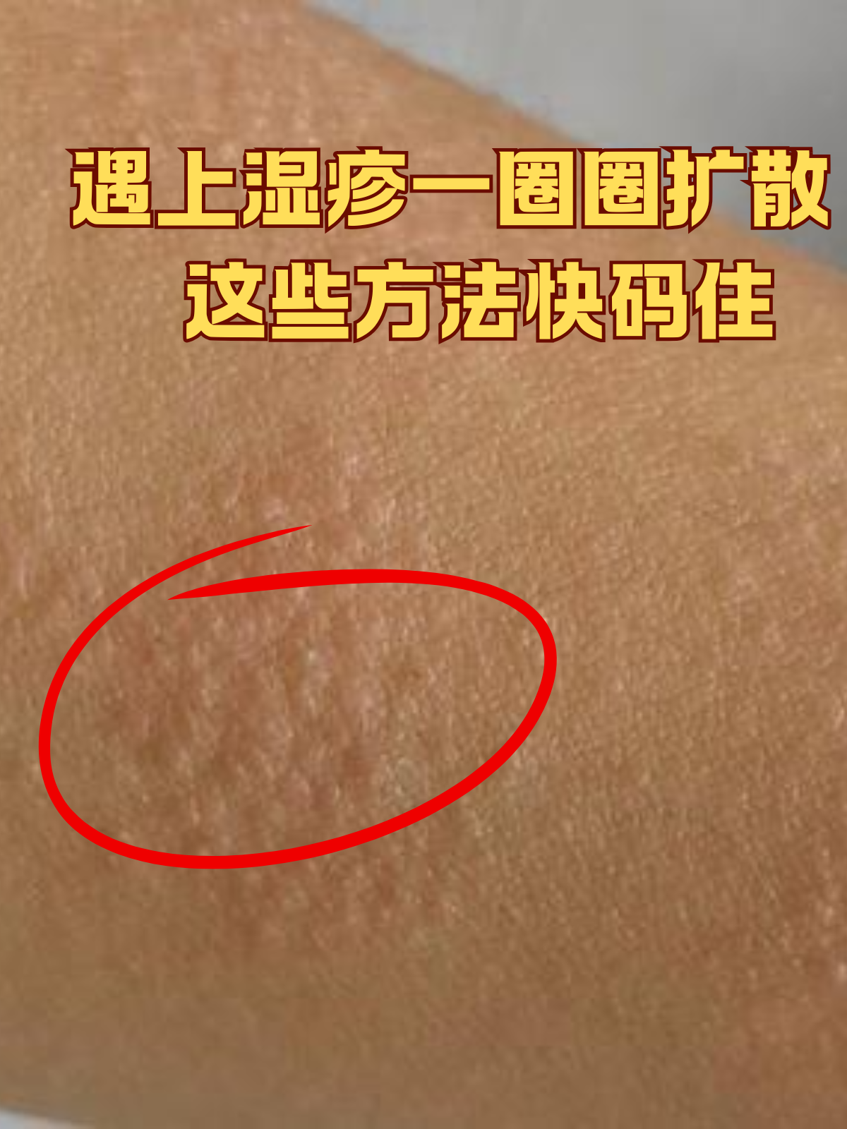 身上为什么会起湿疹 身上为什么会起湿疹