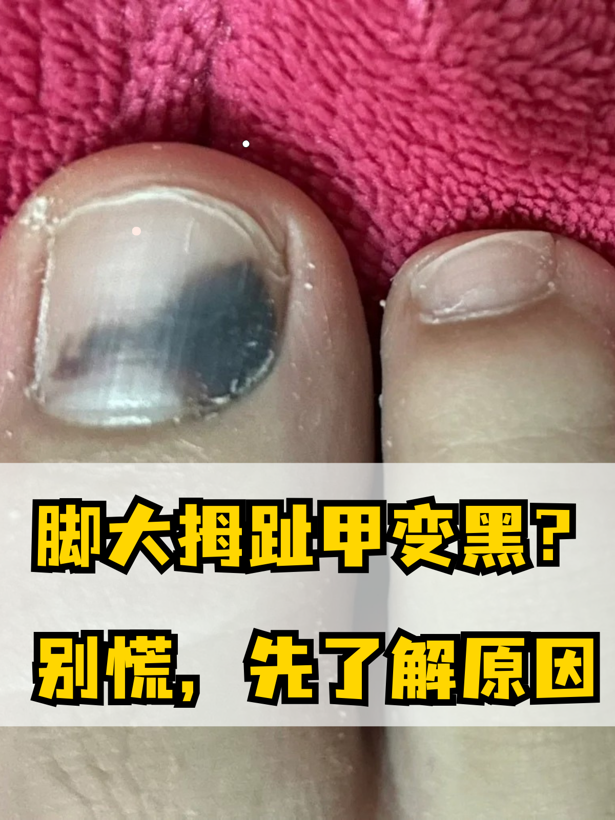大拇指的皮肤既往脚指甲变黑怎么回事指甲变黑是怎么回事大母脚趾莫名